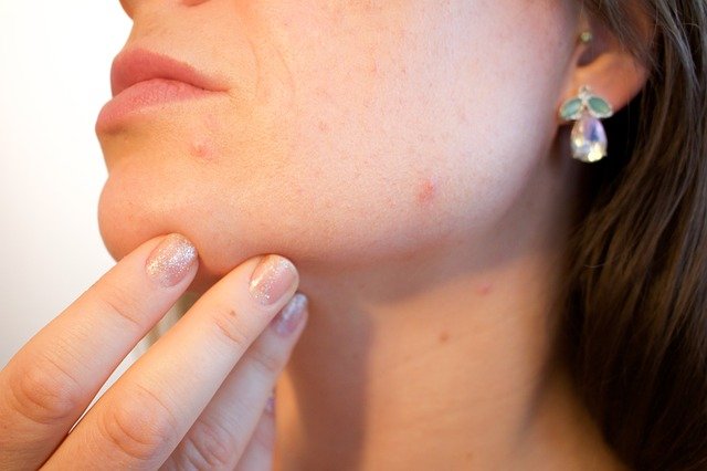 Free download acne pores skin pimple female free picture to be edited with GIMP free online image editor