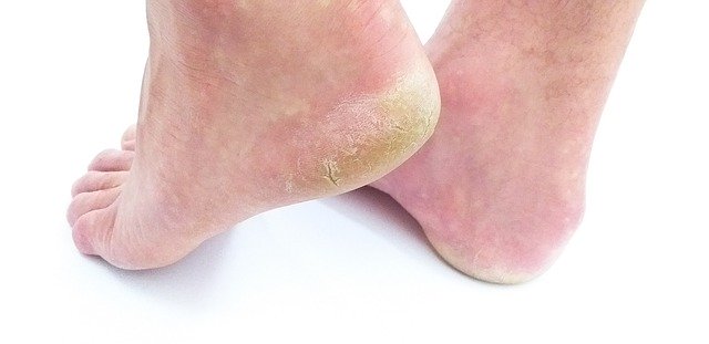 دانلود رایگان Cornea Skin Foot Sole Of The - عکس یا تصویر رایگان قابل ویرایش با ویرایشگر تصویر آنلاین GIMP
