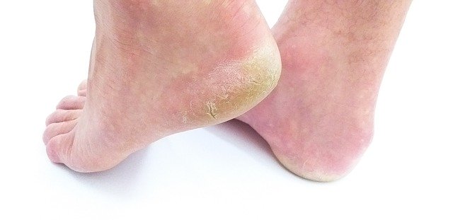 Unduh gratis Cornea Skin Foot Sole Of The - foto atau gambar gratis untuk diedit dengan editor gambar online GIMP