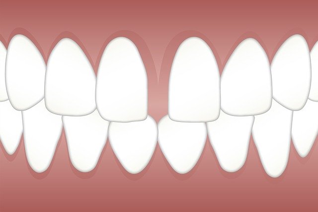 Bezpłatne pobieranie Dental Diastema Space - bezpłatna ilustracja do edycji za pomocą bezpłatnego internetowego edytora obrazów GIMP