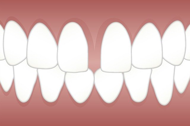 Free download Dental Diastema Space -  free illustration to be edited with GIMP free online image editor