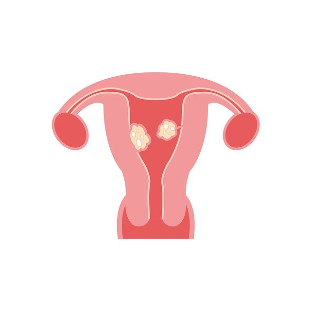 Free download Fibroids Model -  free illustration to be edited with GIMP free online image editor