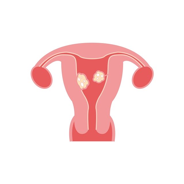 Libreng download Fibroids Model - libreng ilustrasyon na ie-edit gamit ang GIMP na libreng online na image editor