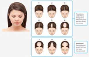Free download Get the Top Platelet-rich PlasmaTherapy for Hair Growth - Revital Trichology free photo or picture to be edited with GIMP online image editor