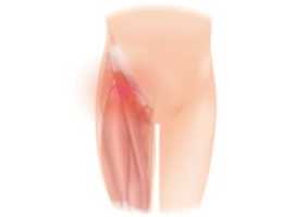Free download Hip Groin Pain free photo or picture to be edited with GIMP online image editor