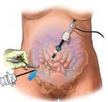 Free download laproscopy free photo or picture to be edited with GIMP online image editor