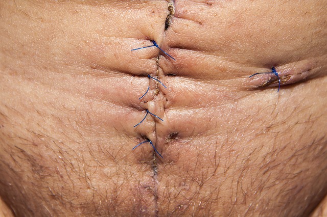 Free download op operation abdomen surgery free picture to be edited with GIMP free online image editor