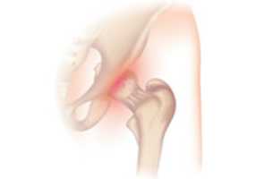 Free download Osteoarthritis In The Hip free photo or picture to be edited with GIMP online image editor