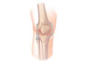 Free download Osteoarthritis of the knee free photo or picture to be edited with GIMP online image editor