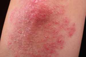 Free download Psoriasis free photo or picture to be edited with GIMP online image editor