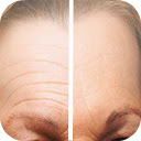 Reduce Forehead Wrinkles  screen for extension Chrome web store in OffiDocs Chromium