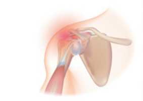 Free download Rotator cuff syndrome free photo or picture to be edited with GIMP online image editor