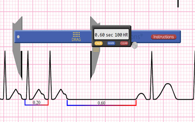 Apex EKG Caliper  from Chrome web store to be run with OffiDocs Chromium online