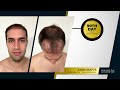 Hair Transplant in Turkey NHT  from Chrome web store to be run with OffiDocs Chromium online