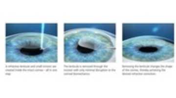 Free download Smile Eye Surgery | webeyeclinic free photo or picture to be edited with GIMP online image editor