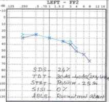 Free download Vestibular Schwannoma free photo or picture to be edited with GIMP online image editor