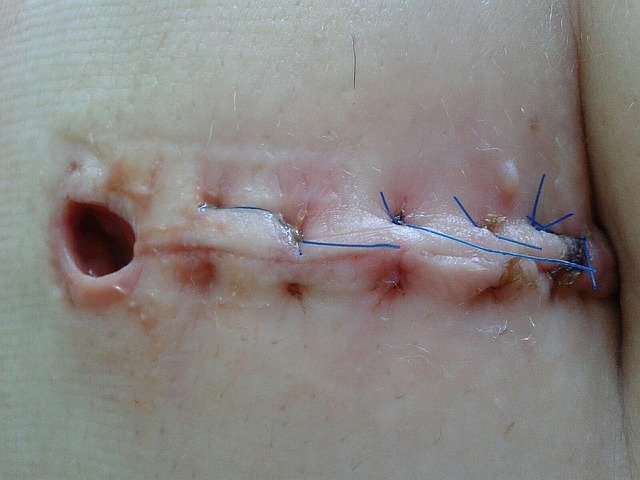 Free download wound operation seam scar thread free picture to be edited with GIMP free online image editor