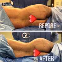 Free download Best Liposuction In Houston free photo or picture to be edited with GIMP online image editor