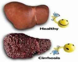 Free download Cirrhosis Of The Liver Treatments Stages Causes Symptoms 300x 238 free photo or picture to be edited with GIMP online image editor