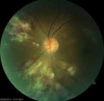 Free download cmv retinitis free photo or picture to be edited with GIMP online image editor