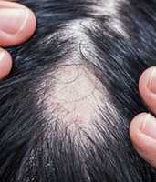 Free download Get the best alopecia treatment in Dubai free photo or picture to be edited with GIMP online image editor