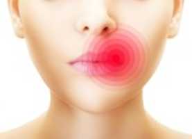 Free download Herpes Virus Manifested On Female Upper Lip E 1397119919588 free photo or picture to be edited with GIMP online image editor