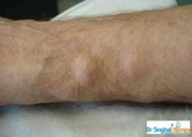 Free download Homeopathic Medicine for Lipoma free photo or picture to be edited with GIMP online image editor