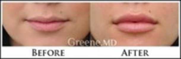 Free download Lip Enlargement in Dubai free photo or picture to be edited with GIMP online image editor