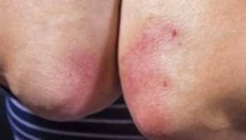 Free download Psoriasis_healthnice free photo or picture to be edited with GIMP online image editor