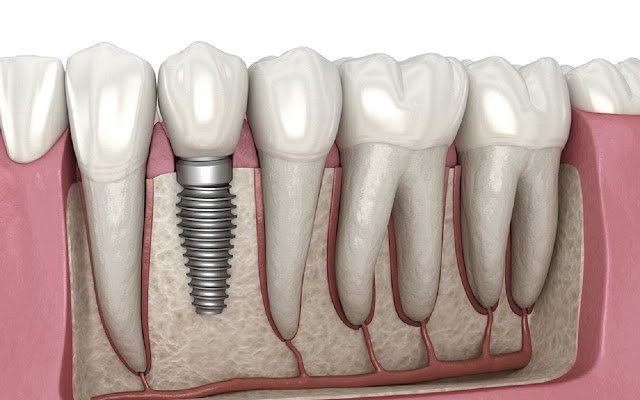 Nangungunang Mga Serbisyo ng Dental Implant mula sa Chrome web store na tatakbo sa OffiDocs Chromium online