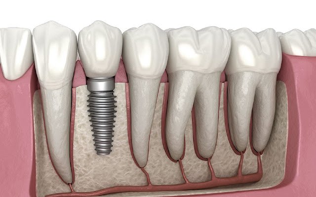 Os principais serviços de implantes dentários da Chrome Web Store serão executados com o OffiDocs Chromium online