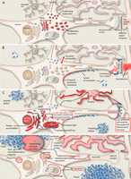 Free download Subcellular injuries in Alzheimers disease: illustration of four stages free photo or picture to be edited with GIMP online image editor