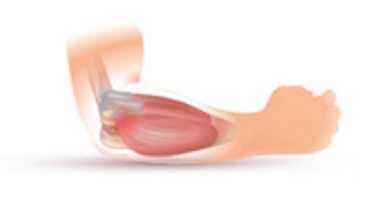 Free download Tennis Elbow / Golf Elbow free photo or picture to be edited with GIMP online image editor