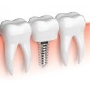 Pantalla de servicios de implantes dentales superior para la extensión Chrome web store en OffiDocs Chromium