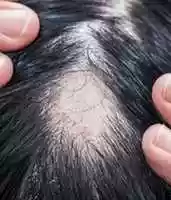 Free download Get the best alopecia treatment in Dubai free photo or picture to be edited with GIMP online image editor