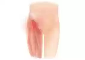 Free download Hip Groin Pain free photo or picture to be edited with GIMP online image editor