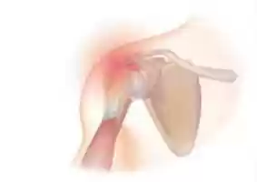 Free download Rotator cuff syndrome free photo or picture to be edited with GIMP online image editor
